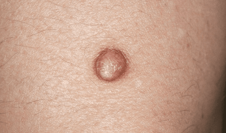 Mazs kupola formas brūngans dermatofibromas veidojums uz ādas – labdabīgs un ciets mezgliņš.