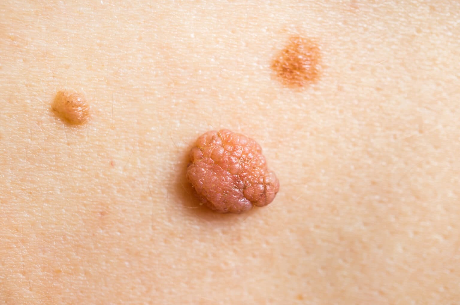 Izciļņveida papiloma un divi pigmentēti dzimumzīmes uz ādas – bieži ādas veidojumi, ko izvērtē dermatologs konsultācijā.