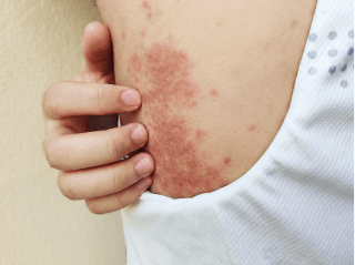 /images/dermatitis/trail-12.png