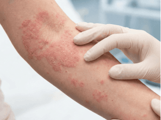 /images/dermatitis/trail-7.png