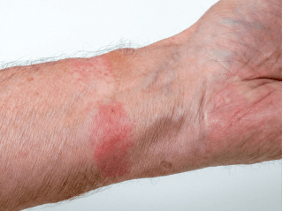 /images/dermatitis/trail-8.png