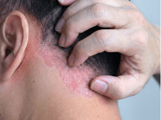 /images/dermatitis/trail-9.png