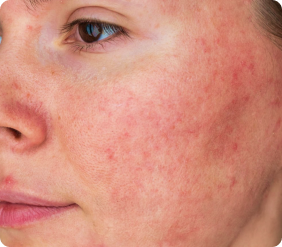 title.erythematous.pink