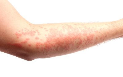 Contact Dermatitis