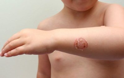 Infekciozā impetigo: Cēloņi, simptomi un ārstēšana