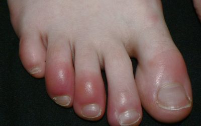 Chilblains (Pernio)