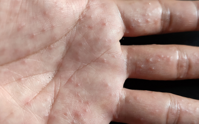 Dishidrotic eczema