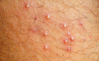 Folliculitis