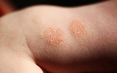 Monētu formas (Numulārais) dermatīts: Cēloņi, simptomi un ārstēšana