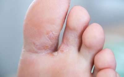 Athlete’s Foot: Causes, Symptoms, and Effective Treatment