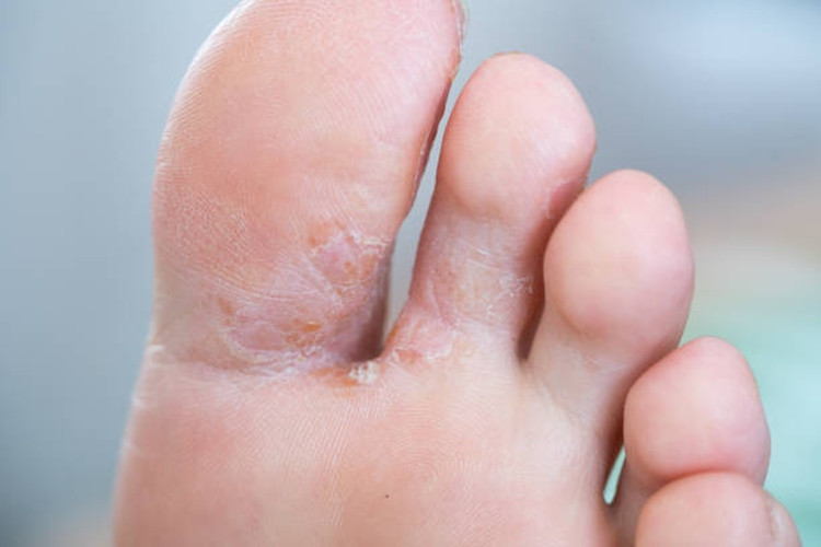 Foot fungus Skin disease Dermatology