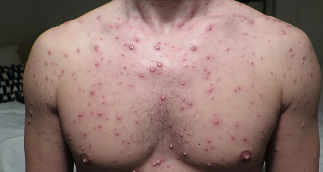 Chickenpox on the body skin disease