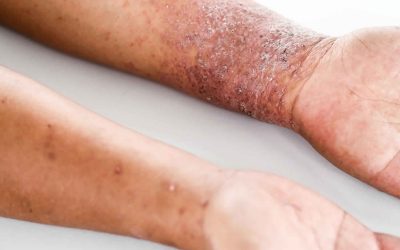 Atopiskais dermatīts: Cēloņi, simptomi un ārstēšanas metodes