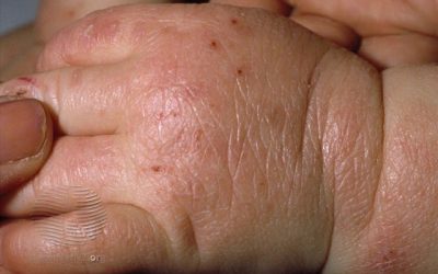 Atopic Dermatitis in Children: Causes, Symptoms, and Treatment