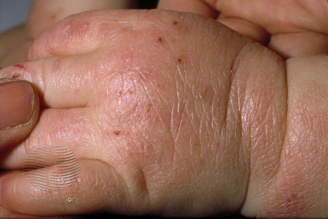 Atopic-dermatitis-in children