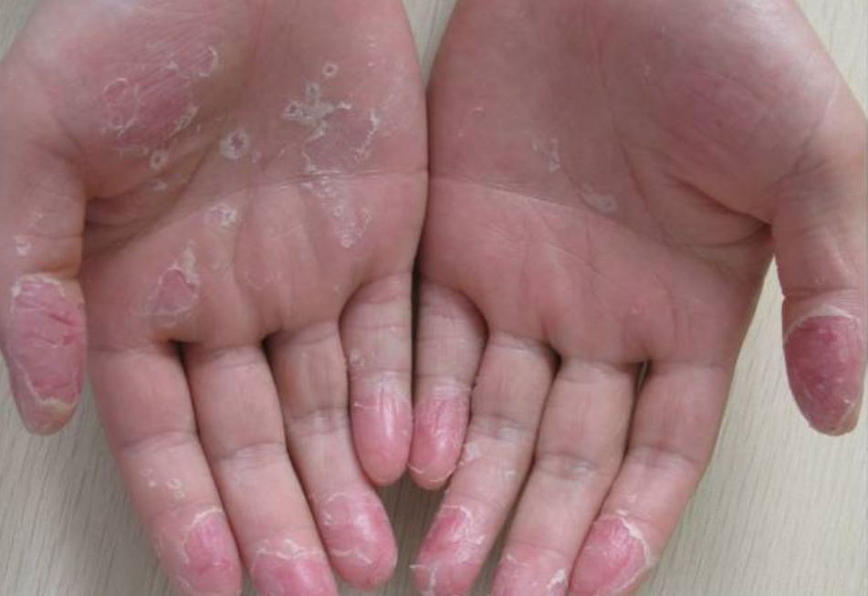 Keratolysis exfoliativa hands