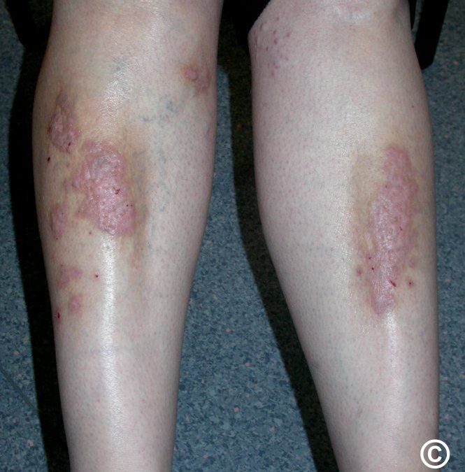 Lichen Planus: Causes, Symptoms, and Treatment Options