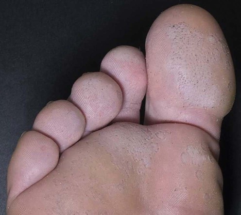 Pitted Keratolysis soles