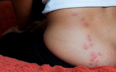 Insect Bites: Symptoms, Treatment, and Prevention Tips