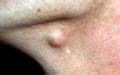 Epidermoid Cysts: Causes, Symptoms, and Treatment Options