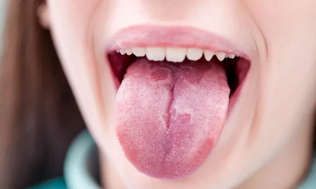 Geographic Tongue: Causes, Symptoms, and Treatment Options