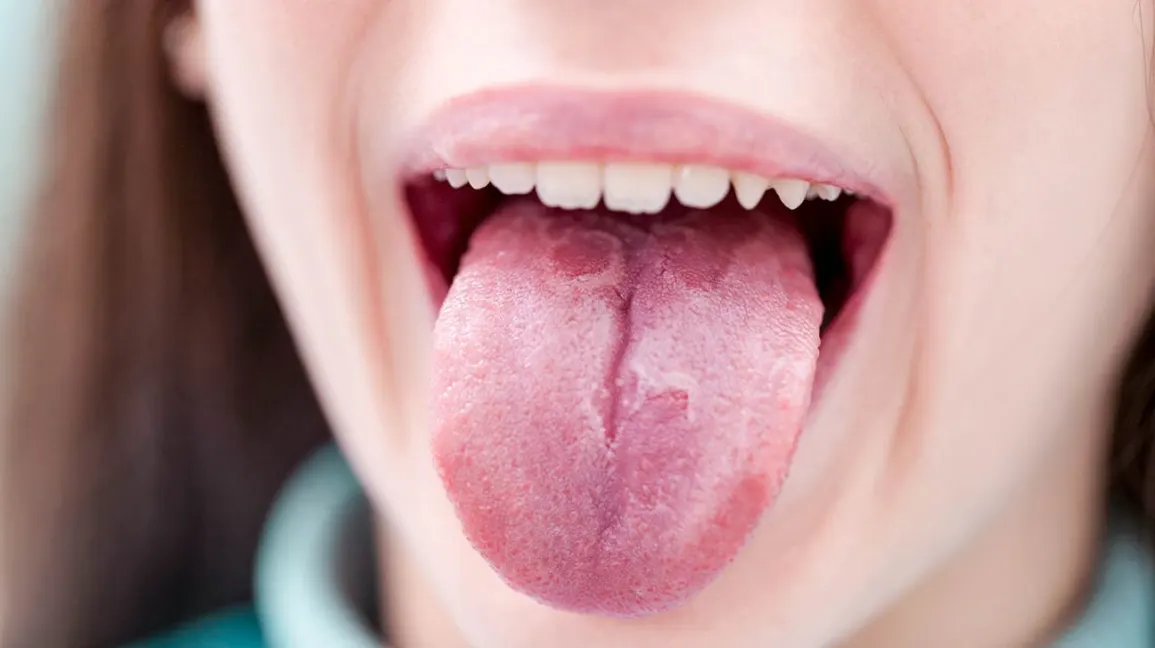 Geographic tongue adult