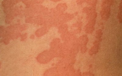 Acute Urticaria: Causes, Symptoms, and Treatment Options