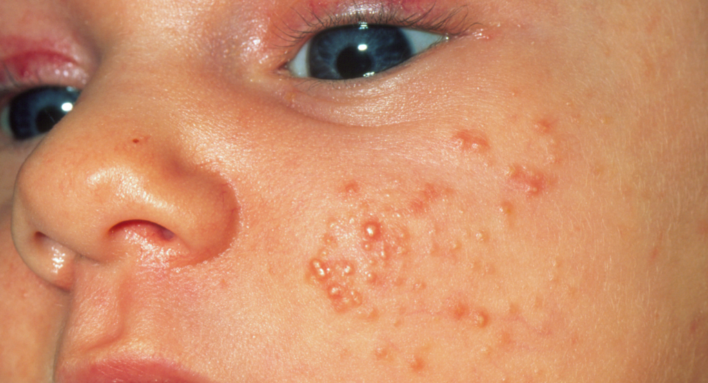 newborn acne