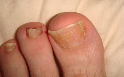 Nail psoriasis