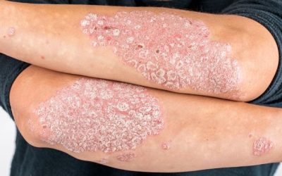 Psoriāze: Simptomi, cēloņi un efektīva ārstēšana