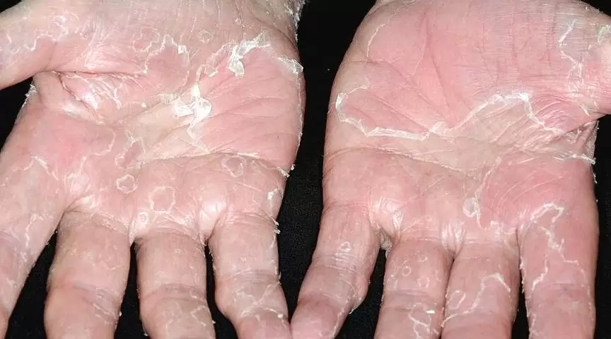 Peeling skin syndrome 2