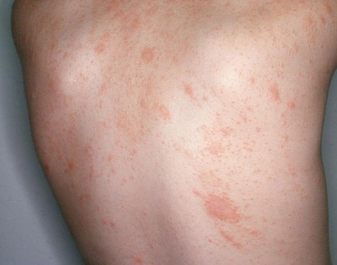 Pityriasis rosea (lot. Pityriasis rosea).