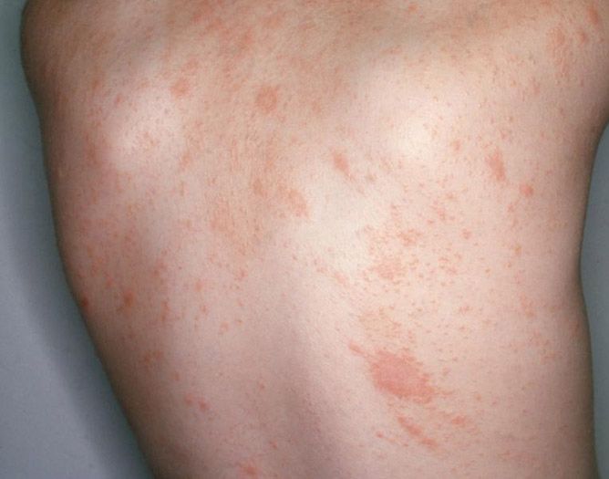 Rozācija: Simptomi, cēloņi un efektīva ārstēšana