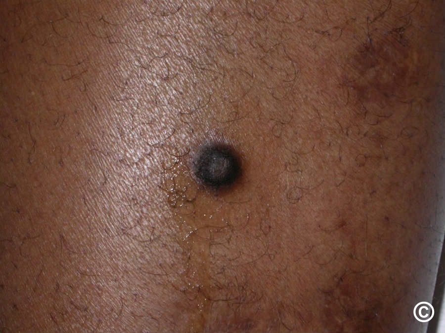 Dermatofibroma histiocytoma darkskin