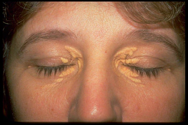 Ksanteliazma xanthelasma eye akis