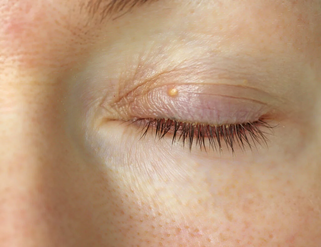 Ksanteliazma xanthelasma eye akis