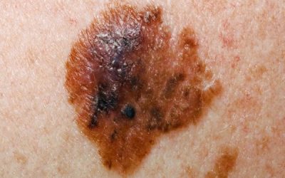 Melanoma