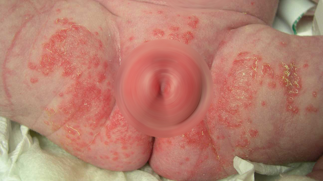 Candidiasis rash on skin