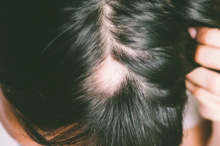 Focal alopecia bald patches on scalp