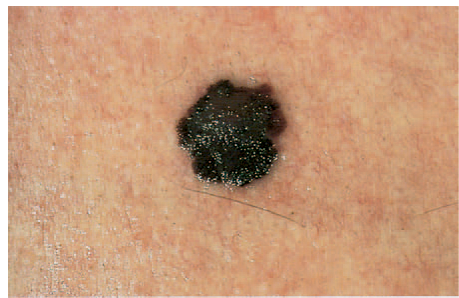 Melanoma (Piktybinis apgamas) 3