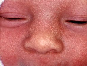 Newborn skin rash close-up