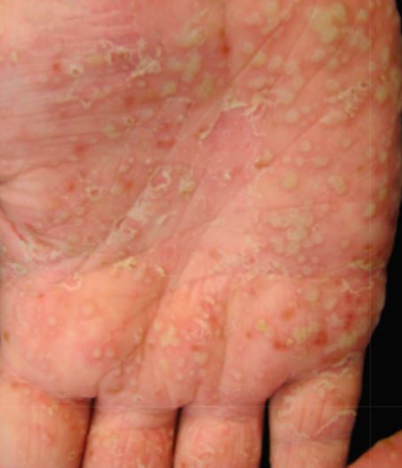 Palmoplantar pustulosis pustules on hands