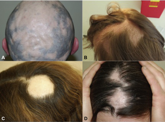 Patchy hair loss from focal alopecia