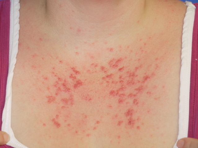 Polymorphic light eruption rash on skin