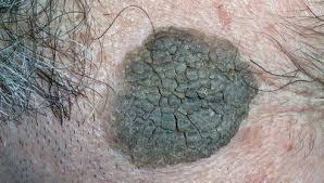 Seborrhoeic keratosis