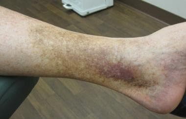 Stasis dermatitis on lower legs