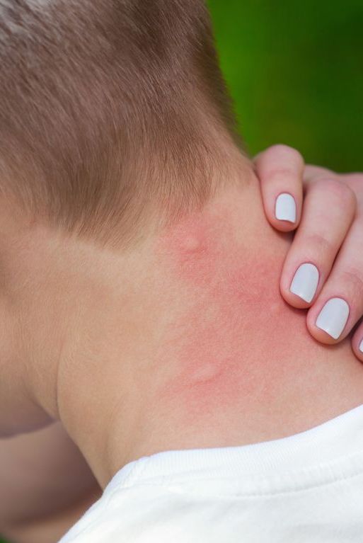 Swollen insect bite close-up