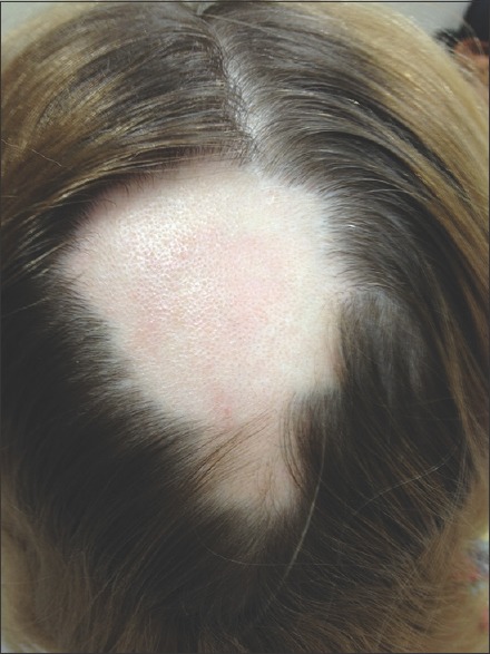 Treatment for focal alopecia