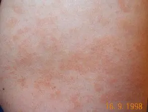 Kapilarīta diagnostika: dermatologa veiktā ādas pārbaude<br />
