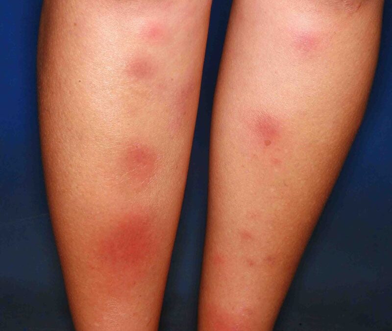Mezglainā eritēma: Cēloņi, Simptomi un Ārstēšana